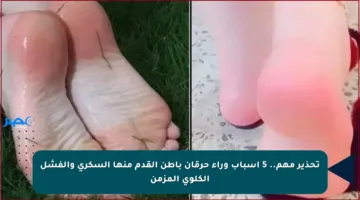 تحذير مهم.. 5 أسباب وراء حرقان باطن القدم منها السكري والفشل الكلوي المزمن